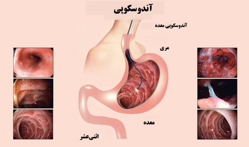 اندوسکوپی تشخیصی در مشکلات گوارشی: از زخم معده تا حساسیت‌های غذایی کودکان اصفهان