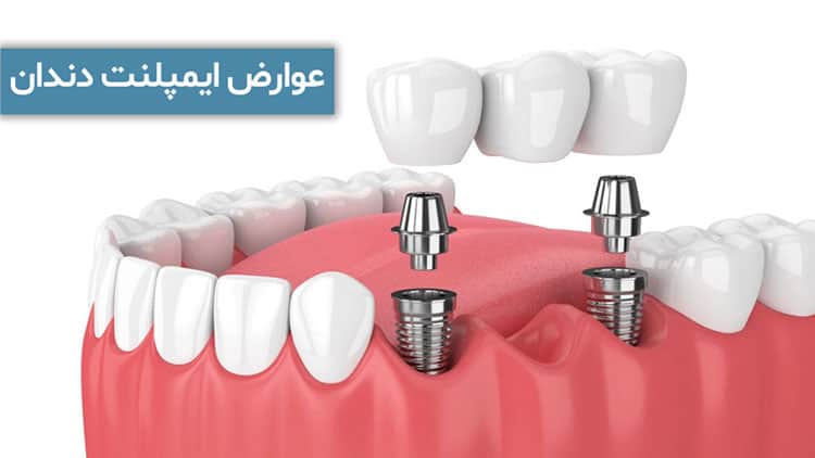 عوارض ایمپلنت دندان | واقعیت‌ها و راه‌های پیشگیری
