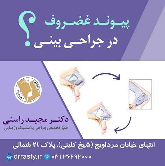 پیوند غضروف در جراحی بینی