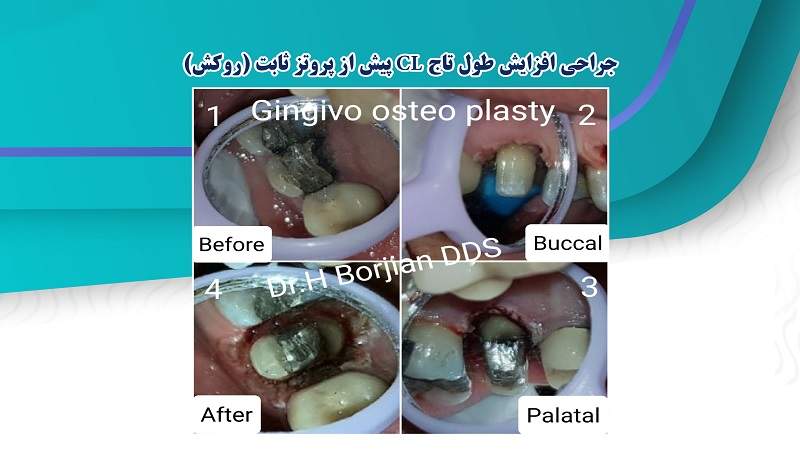 جراحی افزایش طول تاج CL پیش از پروتز ثابت (روکش)