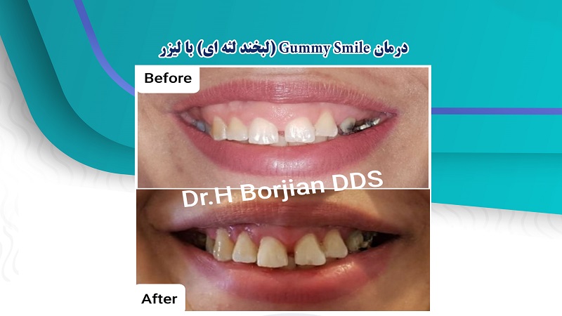 درمان Gummy Smile (لبخند لثه ای) با لیزر