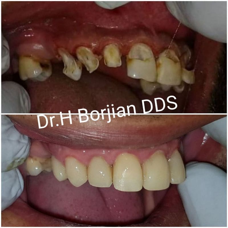 جراحی افزایش طول تاج