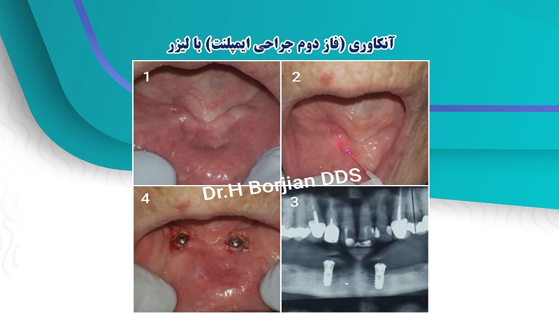 آنکاوری (فاز دوم جراحی ایمپلنت) با لیزر