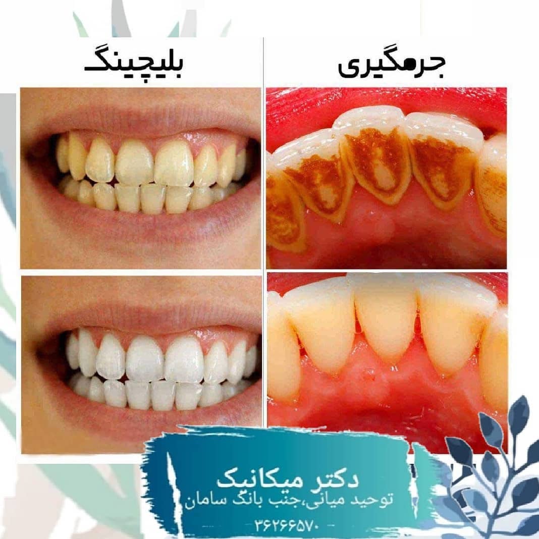 مقایسه جرمگیری و بلیچینگ دندان