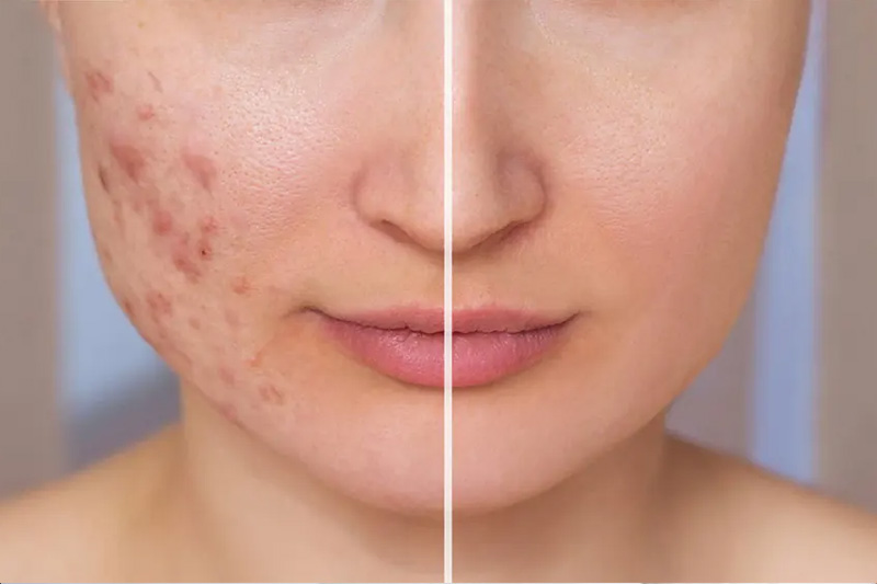 ساب‌سیژن چیست؟ کاربردها، مزایا، عوارض و هزینه ساب‌سیژن برای رفع جای جوش و فرورفتگی پوست