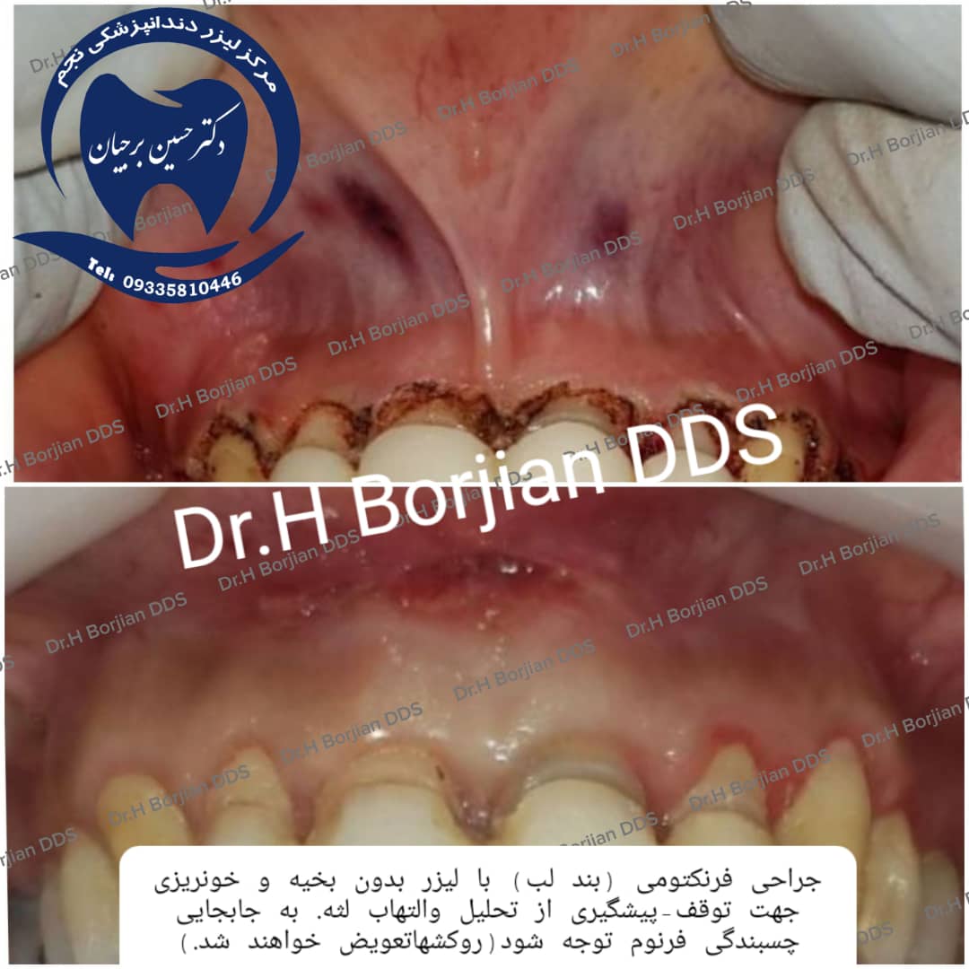 جراحی فرنکتومی ( بند لب )