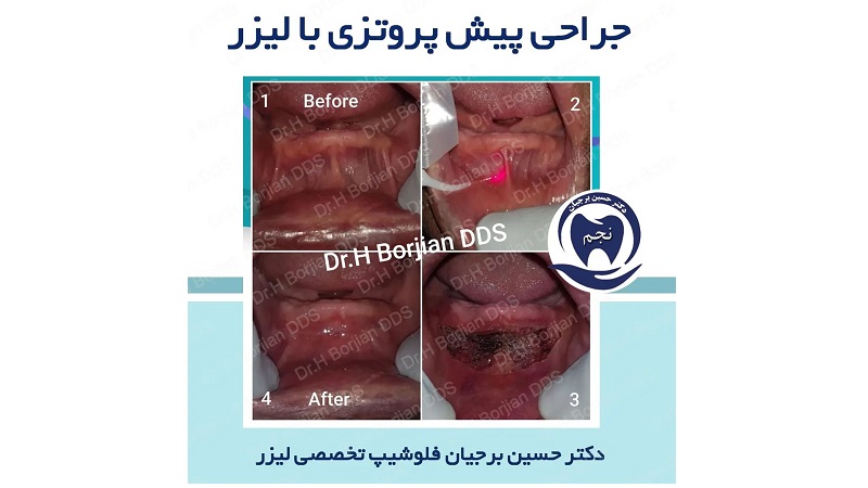 جراحی های پیش پروتزی (وستیبولوپلاستی) با لیزر