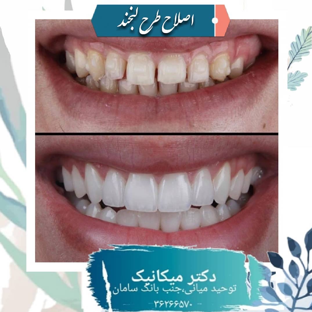 اصلاح طرح لبخند با رنگ و فرم طبیعی