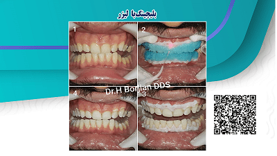 کیس بلیچینگ با لیزر