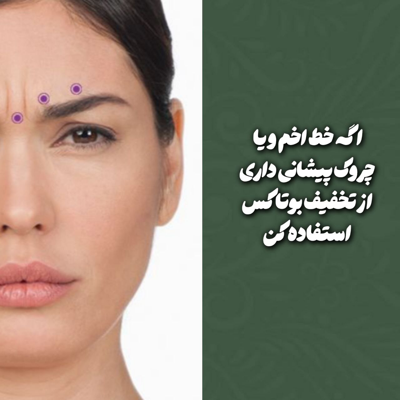 بوتاکس یلدایی؛ تخفیف بوتاکس دیسپورت و مصپورت تا ۲۰٪ در مطب دکتر سید مجید حسینی