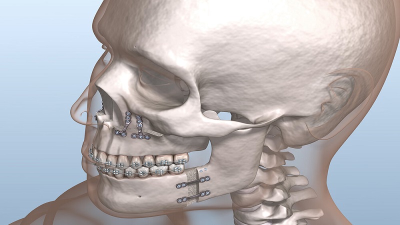 جراحی آرتوگناتیک در اصفهان | ترکیب زیبایی و عملکرد فک
