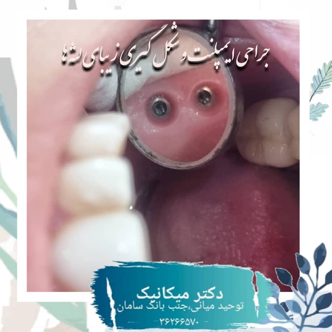 جراحی لثه برای کاشت ایمپلنت