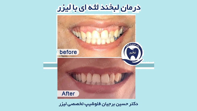 درمان لبخند لثه ای با لیزر