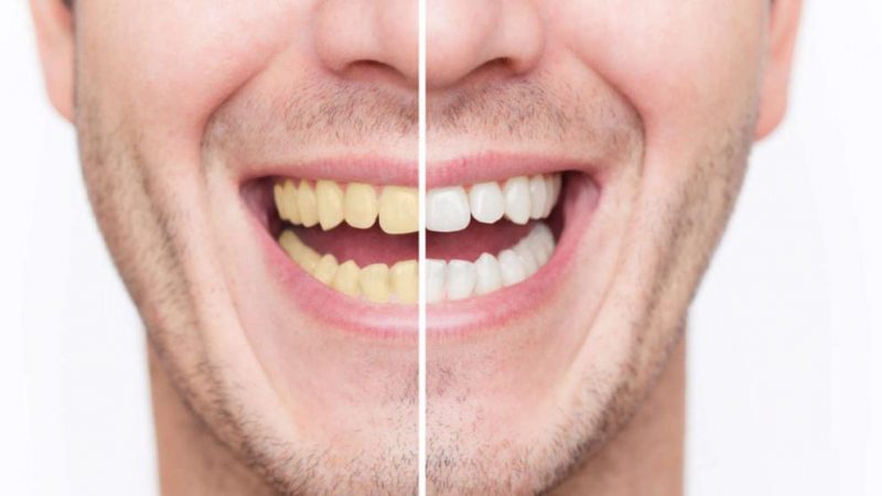 بلیچینگ (سفید کردن دندانها) با لیزر