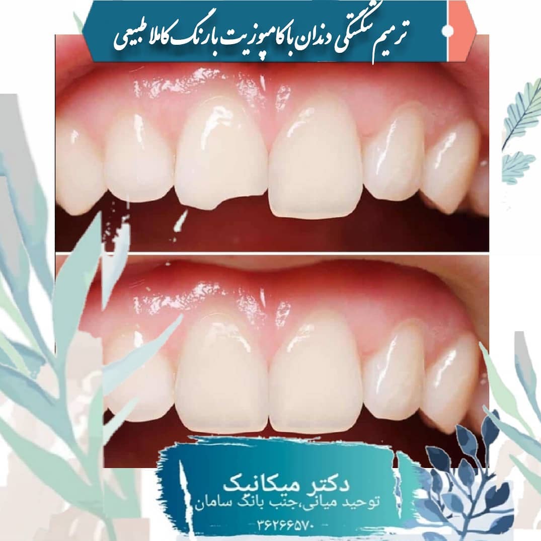 ترمیم شکستگی دندان با کامپوزیت و رنگ کاملا طبیعی