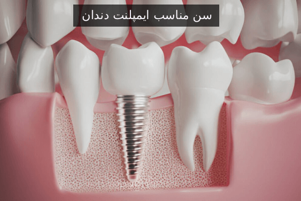 بهترین سن برای ایمپلنت دندان | نکات مهم برای ماندگاری طولانی