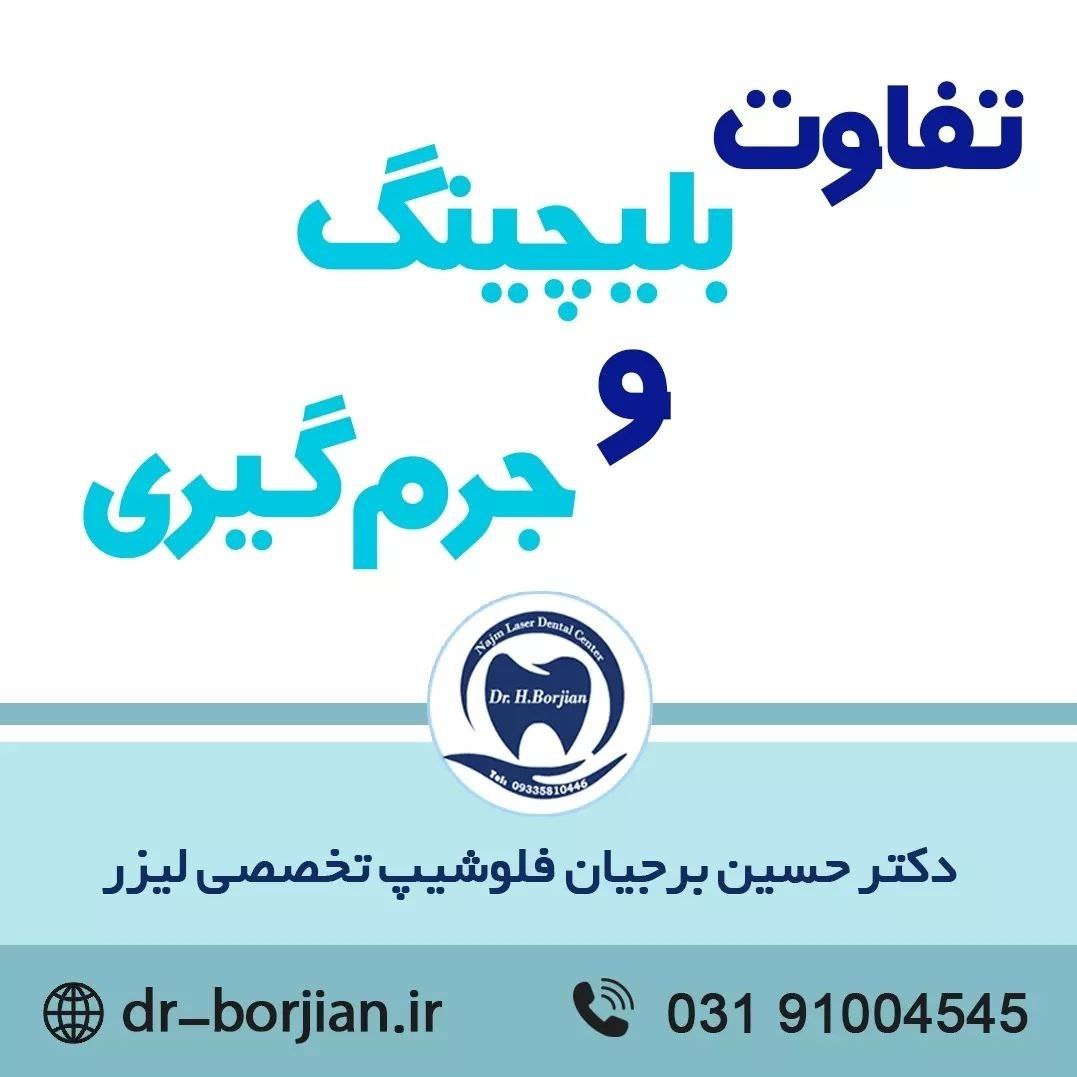 تفاوت بلیچینگ و جرم گیری دندان