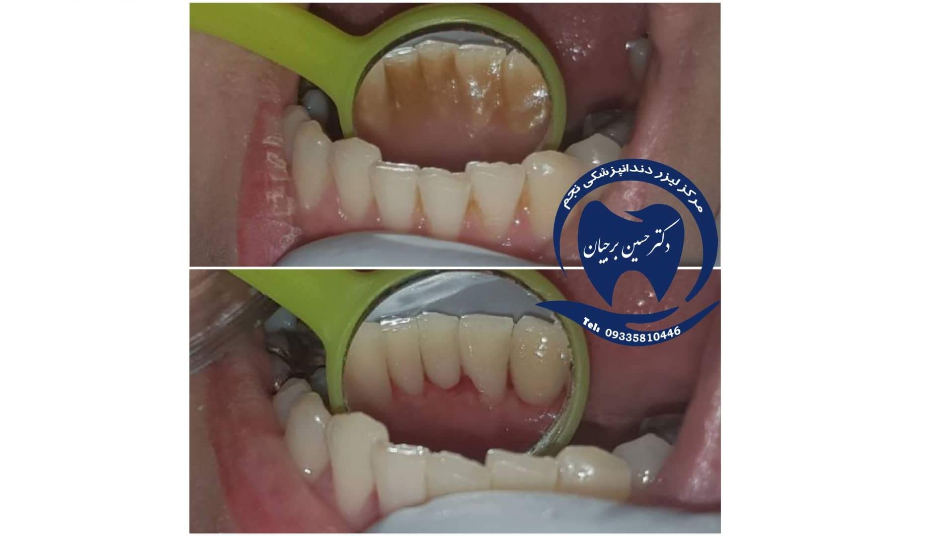 جرمگیری با امواج اولتراسونیک
