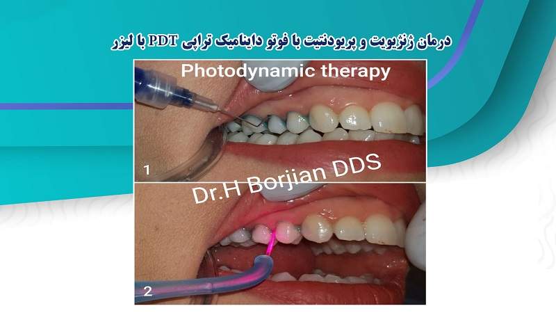 درمان ژنژیویت و پریودنتیت با فوتو داینامیک تراپی PDT با لیزر