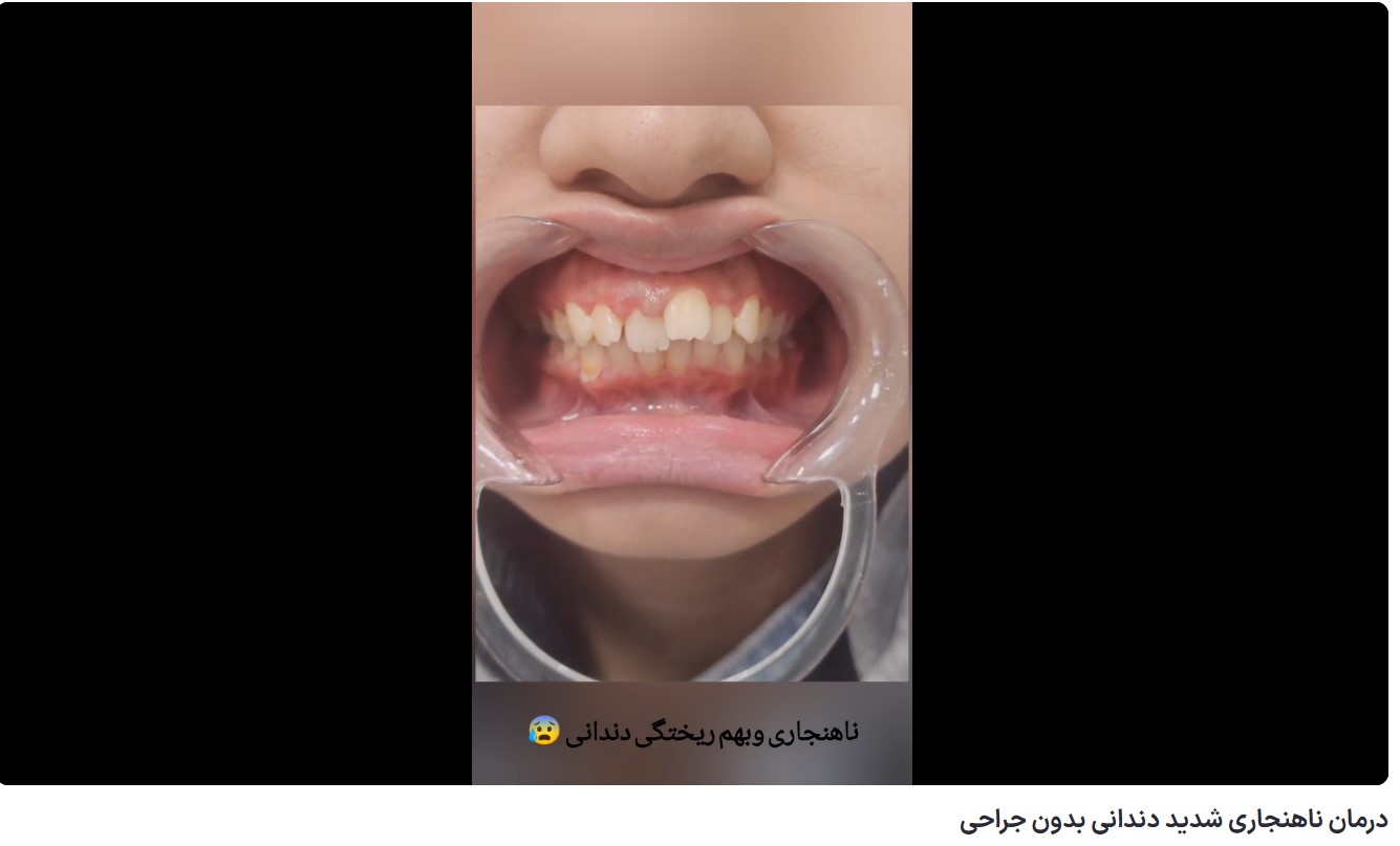 درمان ناهنجاری شدید دندانی بدون جراحی