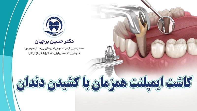 کشیدن دندان و کاشت همزمان ایمپلنت دندان