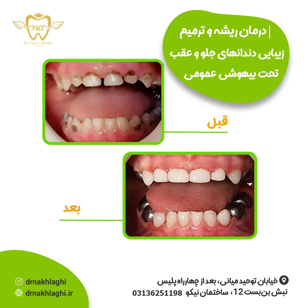 درمان ریشه و ترمیم دندانها