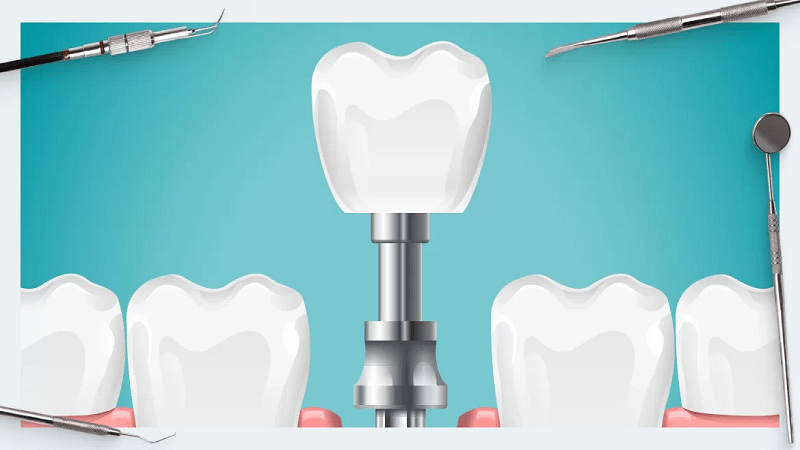 بهترین درمان جایگزینی دندان چیه؟