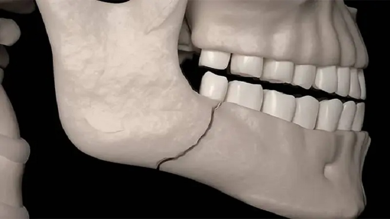 اختلالات حسی صورت با شکستگی فک