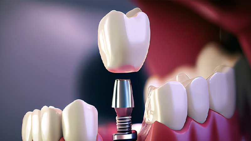 اهمیت برند ایمپلنت دندان و تخصص کاشت ایمپلنت دندان