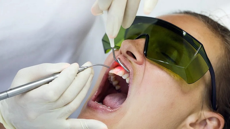 کاربردهای لیزر اربیوم در دندانپزشکی