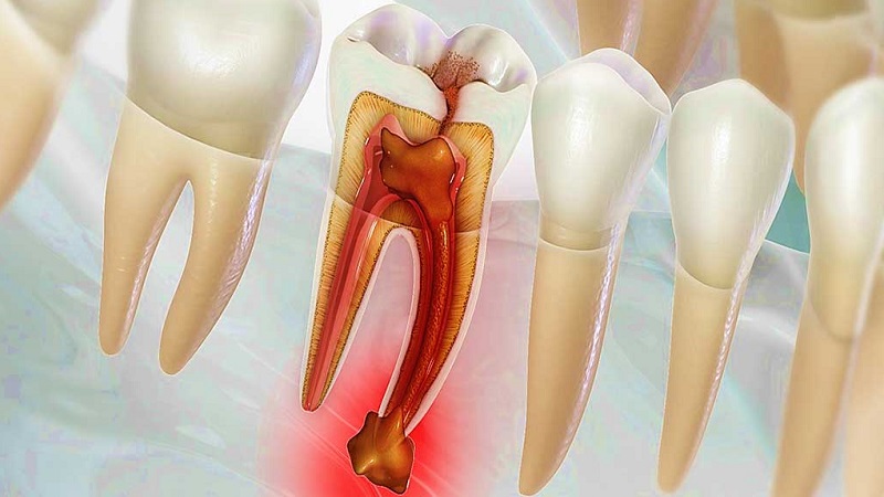 اهمیت کشیدن ریشه دندان عفونی